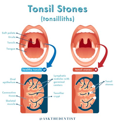 Tonsil Stone